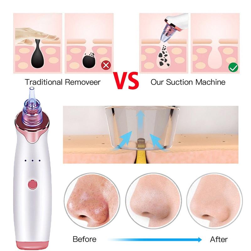 Multifunctional Beauty Pore Vacuum 4 in 1 - Trendy Planet
